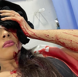 Joven agredida agredida en discoteca tiene 50 puntos de sutura y necesitará cirugía