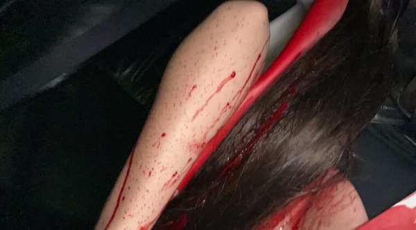 Piden detención para infeliz que reventó a yiyi con vaso en una disco