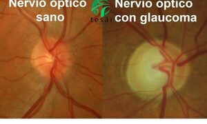 GLAUCOMA, UN ENEMIGO SILENCIOSO