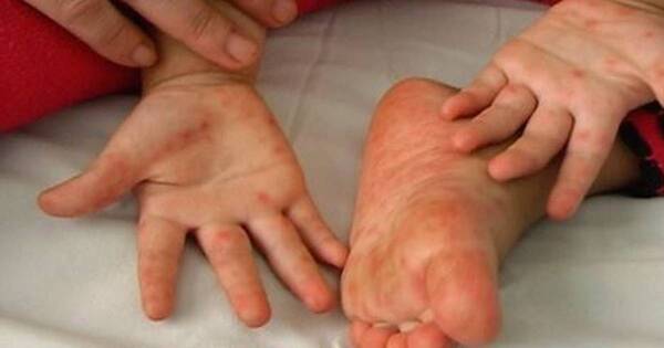 La Nación / Enfermedad de manos, pies y boca es frecuente en niños pequeños
