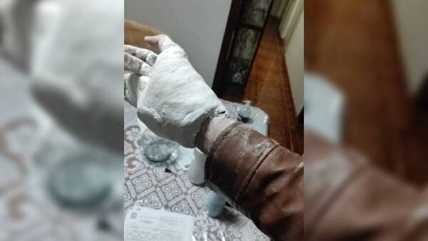 Crónica / Joven se rompió la mano y fue enyesado con ¡campera y todo!