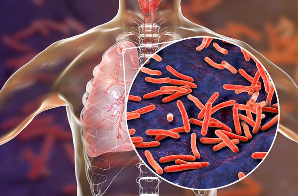 Diario HOY | Día mundial de la Tuberculosis: qué es y cómo se trata