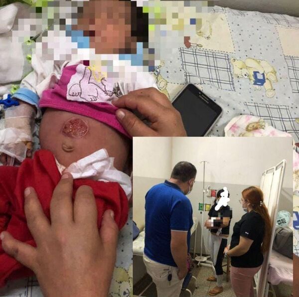 Niña de 40 días sufrió quemadura a causa de un carbón encendido - Radio Imperio