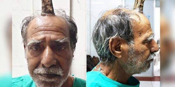 Crónica / Hombre se liberó de "su cuerno" luego de 5 años de aguante