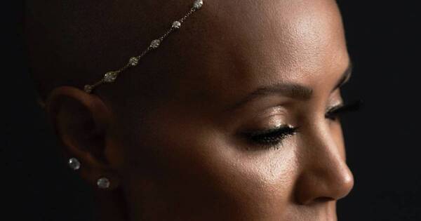 La Nación / Bofetada viral en los Oscars visibilizó la alopecia femenina: quiénes pueden padecerla