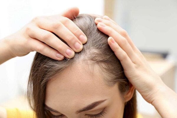 Discriminación acecha a pacientes con alopecia - El Independiente