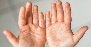 Advierten que el virus de manos, pies y boca es más frecuente en menores de 5 años