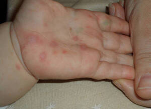 ¿Qué es el virus de manos, pies y boca que ataca a menores de 5 años?