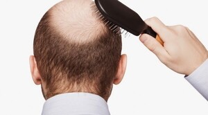 Diario HOY | Pérdida del cabello podría tener varios factores y causas