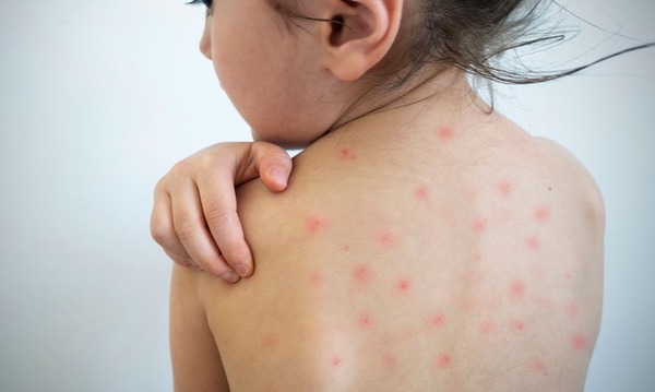 PAI alerta sobre sarampión  e insta a padres a vacunar a niños