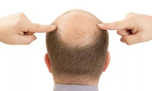 En “Vive la vida” hablaron de la alopecia | Telefuturo