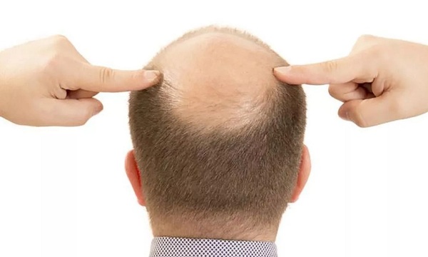 En “Vive la vida” hablaron de la alopecia | Telefuturo