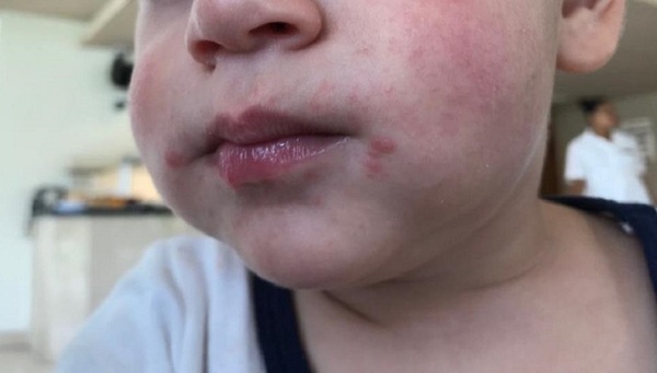 Suman los casos de contagio del virus de pie, mano y boca - La Clave