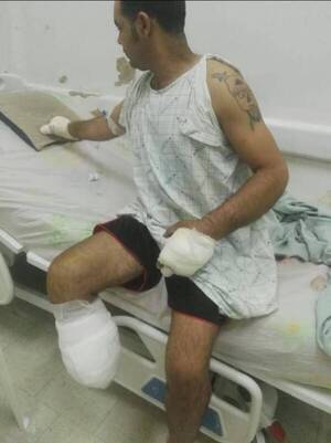 Crónica / Perdió una pierna tras accidente laboral, y ahora pide ayuda