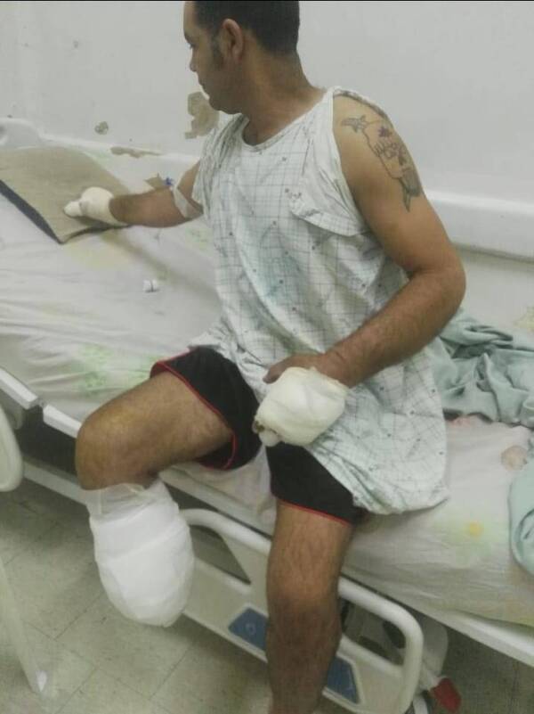 Crónica / Perdió una pierna tras accidente laboral, y ahora pide ayuda