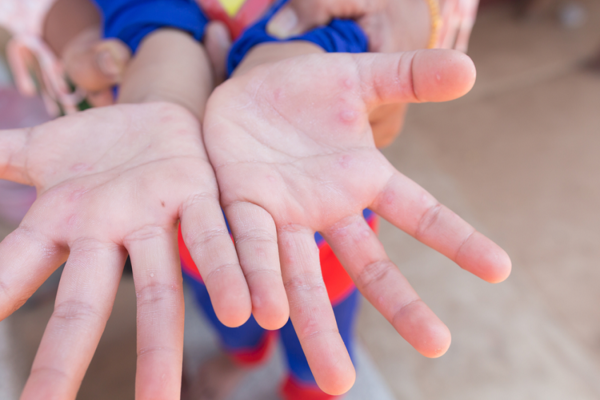 Diario HOY | Aumento de virus de pie, mano y boca: hay que insistir en higiene en niños