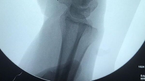 IPS: Pulgarizan con éxito el dedo índice de un hombre
