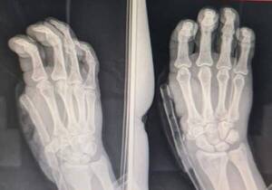 Crónica / Le reemplazaron el dedo, en el lugar del pulgar le colocan el índice