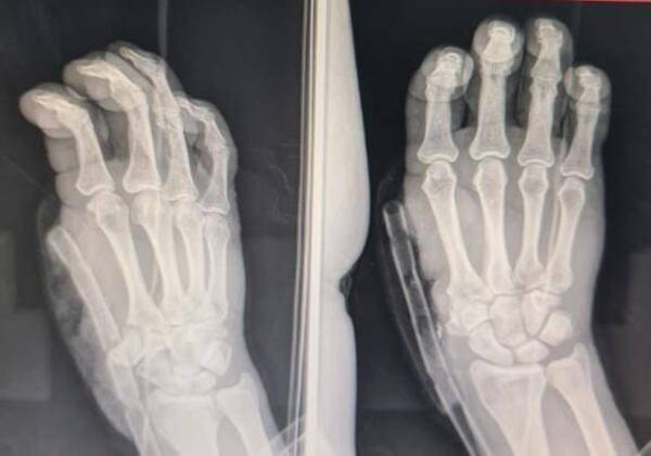 Crónica / Le reemplazaron el dedo, en el lugar del pulgar le colocan el índice
