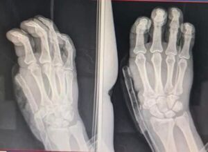 Perdió el pulgar por un escopetazo y médicos de IPS le transfirieron otro dedo en su lugar - Nacionales - ABC Color