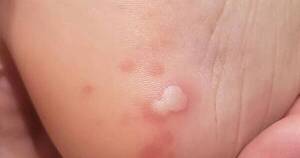 La Nación / Haití advierte sobre una enfermedad cutánea “altamente contagiosa”
