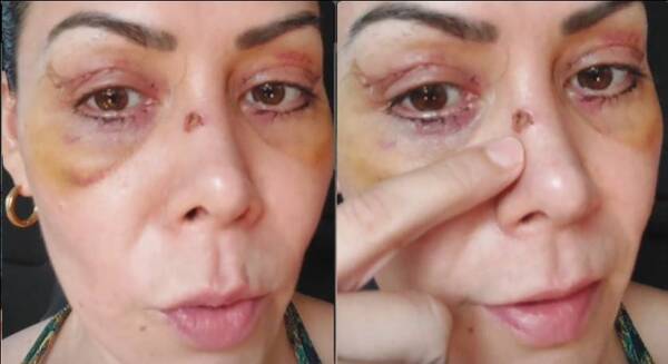 Crónica / ¿Qué le pasó? Exmodelo apareció con la cara llena de moretones