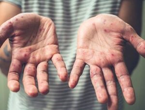 Alertan que enfermedad de manos, pies y boca es muy contagiosa en niños pequeños · Radio Monumental 1080 AM