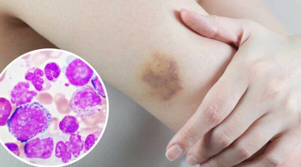 Leucemia Mieloide Aguda: Instan a consultar y estar atentos a los síntomas