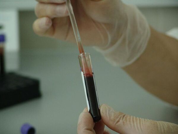 Hoy es el Día Mundial de la leucemia mieloide aguda, un cáncer que afecta más a los adultos - Nacionales - ABC Color