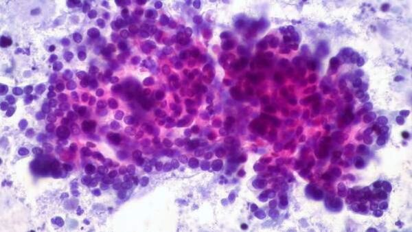 12.000 tumores revelan un "tesoro oculto" de las causas del cáncer