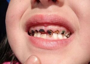 Diario HOY | "Ningún niño debe andar por ahí con los dientes picados": La importancia de tratar las caries