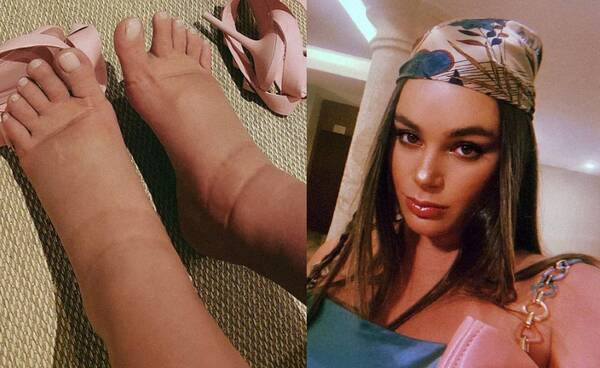 Crónica / ExMiss mostró cómoitepa se le hinchan los pies