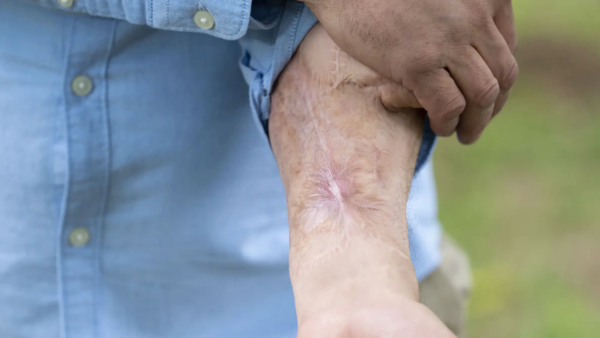 Le injertaron su "amigo" en el brazo y ahora se lo mudaron al lugar correcto