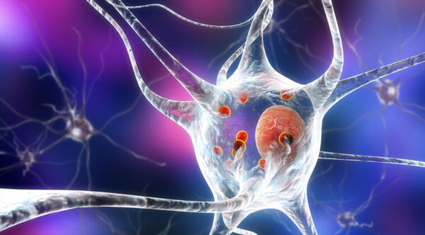 Identifican qué células cerebrales mueren a causa de la enfermedad de Parkinson