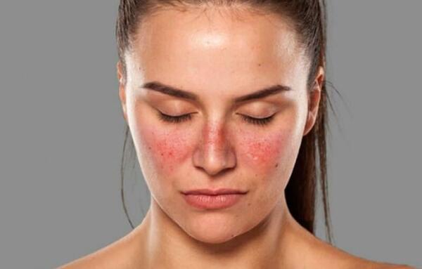 Lupus, la enfermedad que afecta mayormente a mujeres jóvenes