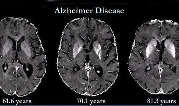 Diario HOY | Descubren cuatro biomarcadores que tendrían nexo con el Alzheimer