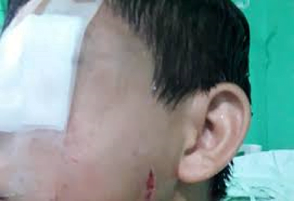 Niño perdió un ojo tras ser golpeado brutalmente por su padrastro - Noticiero Paraguay