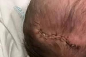 Bebé recién nacida cayó de cabeza minutos después del parto y tuvieron que darle 11 puntos de sutura