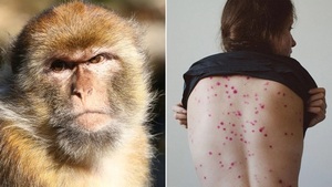 Rara enfermedad preocupa a Europa y EE.UU: Todo lo que hay que saber sobre la viruela del mono