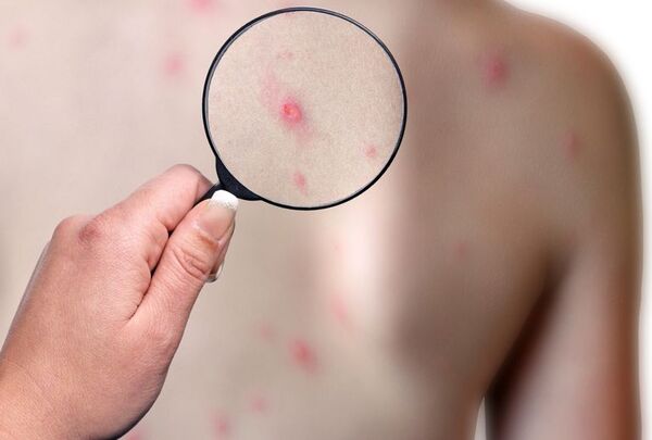La contagiosa “viruela del mono” enciende las alertas sanitarias - Mundo - ABC Color