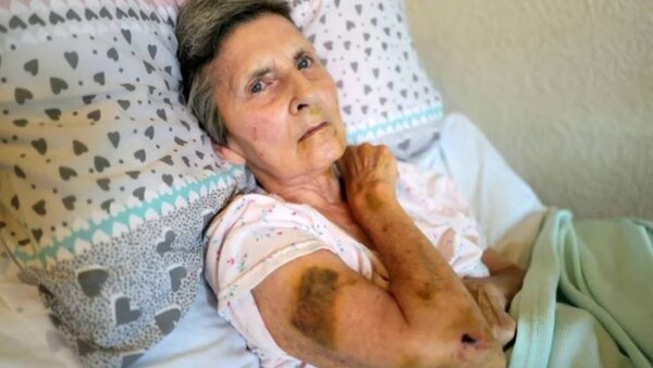 Una abuela fue atacada en el rostro por una rata mientras dormía