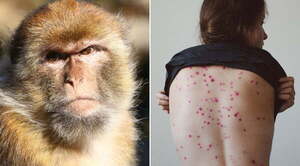 Detectaron el primer caso sospechoso de viruela del mono en la Argentina - Noticiero Paraguay