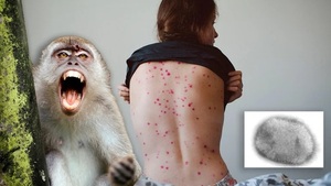 Argentina reporta primer caso sospechoso de viruela del mono