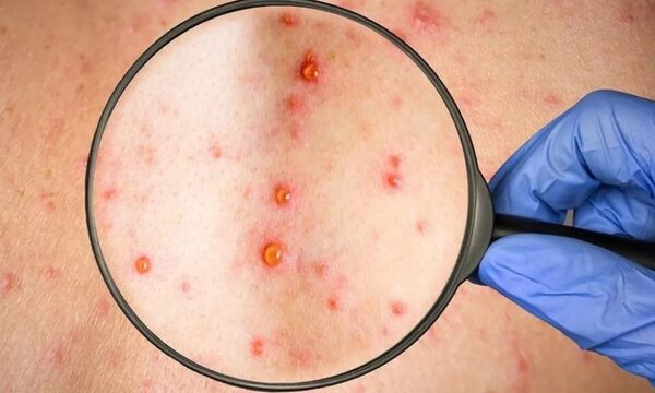 Viruela del mono se propaga con “orgias” y es más común en hombres