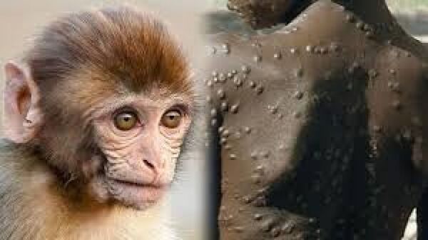 Viruela del mono se pudo haber propagado por contactos sexuales en dos fiestas en Europa