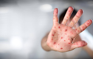 Activan alerta epidemiológica por la viruela de mono