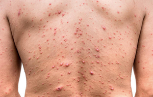 Ante viruela de mono, Salud activa alerta epidemiológica