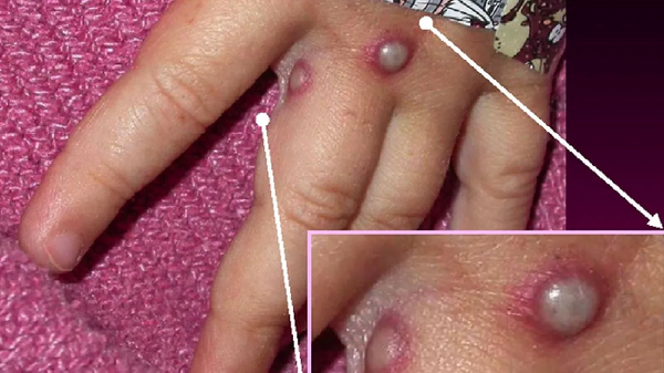 Paraguay activa alerta epidemiológica ante viruela símica - Noticiero Paraguay