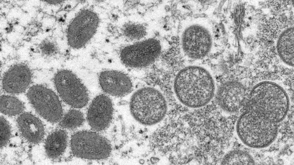 Diario HOY | Viruela del mono: OMS informa que se han registrado 131 casos en 19 países