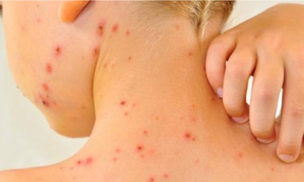 Paraguay activa alerta epidemiológica ante viruela símica - OviedoPress